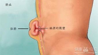 成人脐疝土方治疗视频