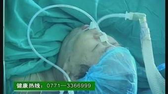 成人脐疝土方治疗视频